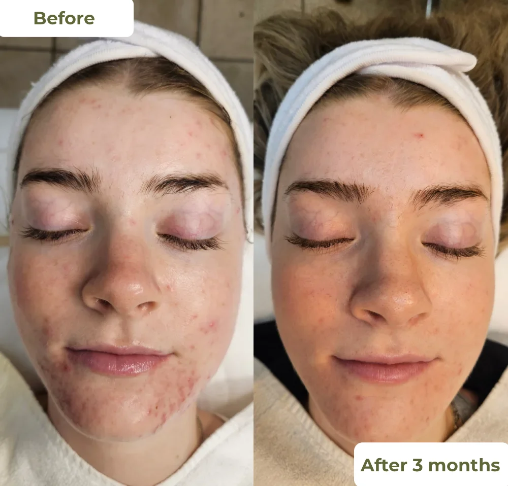 Acne Treatment – How It Works