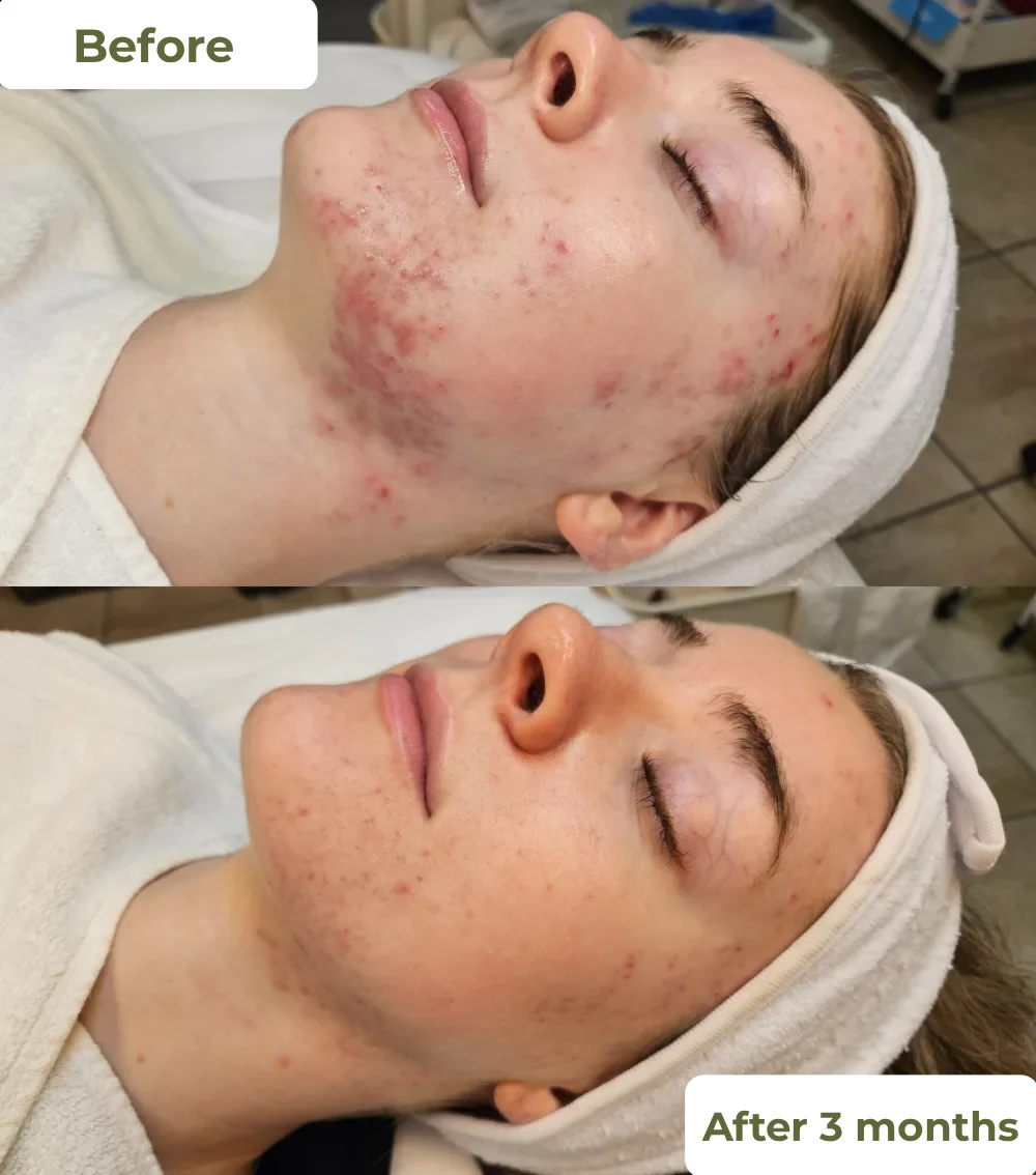 Acne Treatment – How It Works