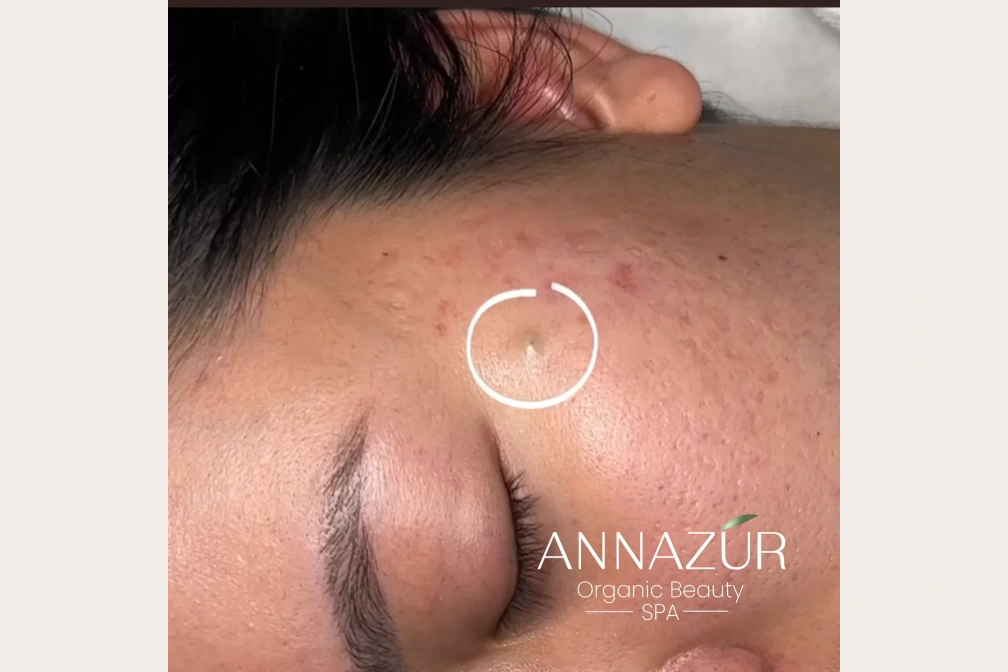 Who is Acne Treatment Suitable For?