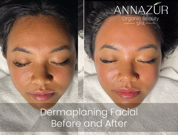 Before and after dermaplaning at ANNAZUR Organic Beauty Spa, Jacksonville FL