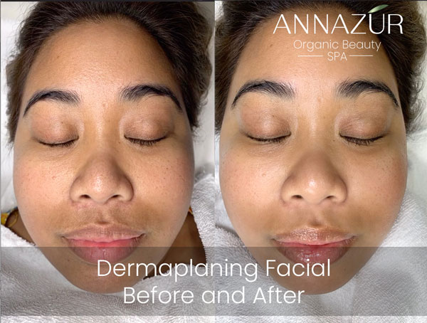 Before and after dermaplaning at ANNAZUR Organic Beauty Spa, Jacksonville FL — photo 4