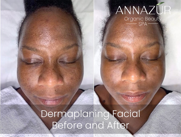Before and after dermaplaning at ANNAZUR Organic Beauty Spa, Jacksonville FL — photo 5