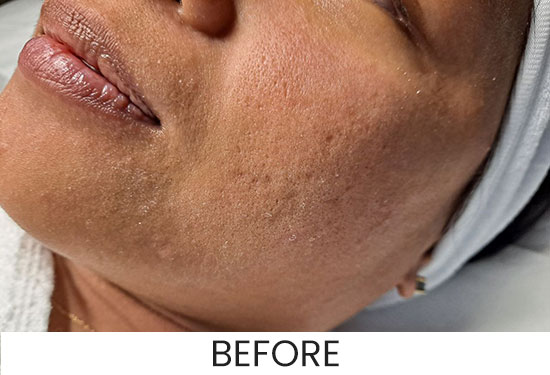 Before and after microdermabrasion in jacksonville at ANNAZUR Organic Beauty Spa, Jacksonville FL