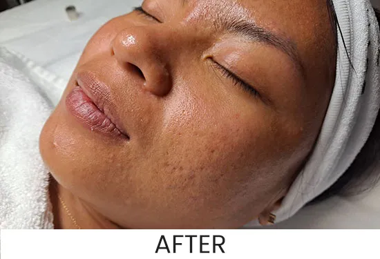 Client's face after a microdermabrasion facial at ANNAZUR