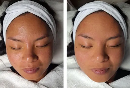 Front-view microdermabrasion before-and-after comparison