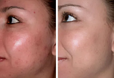 Side-view microdermabrasion before-and-after comparison