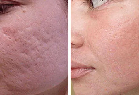 Close-up microdermabrasion before-and-after cheek comparison