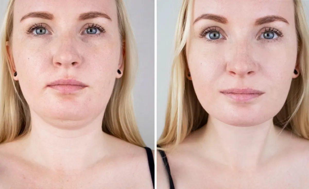 Front-view facial treatment before-and-after comparison