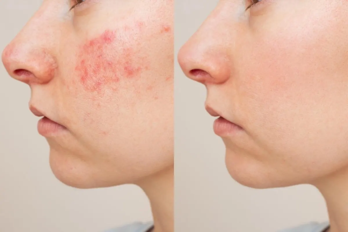 Side-view facial skin before-and-after comparison