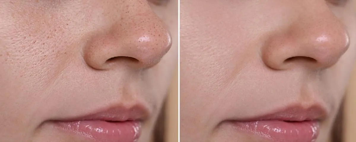 Nose and cheek skin before-and-after comparison