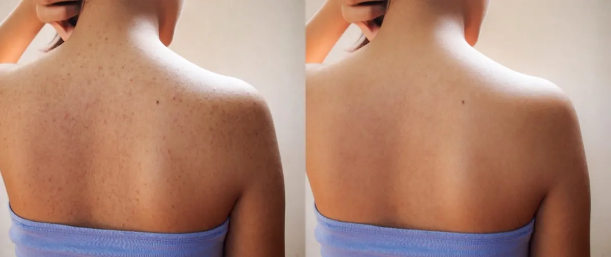 Upper-back skin before-and-after comparison