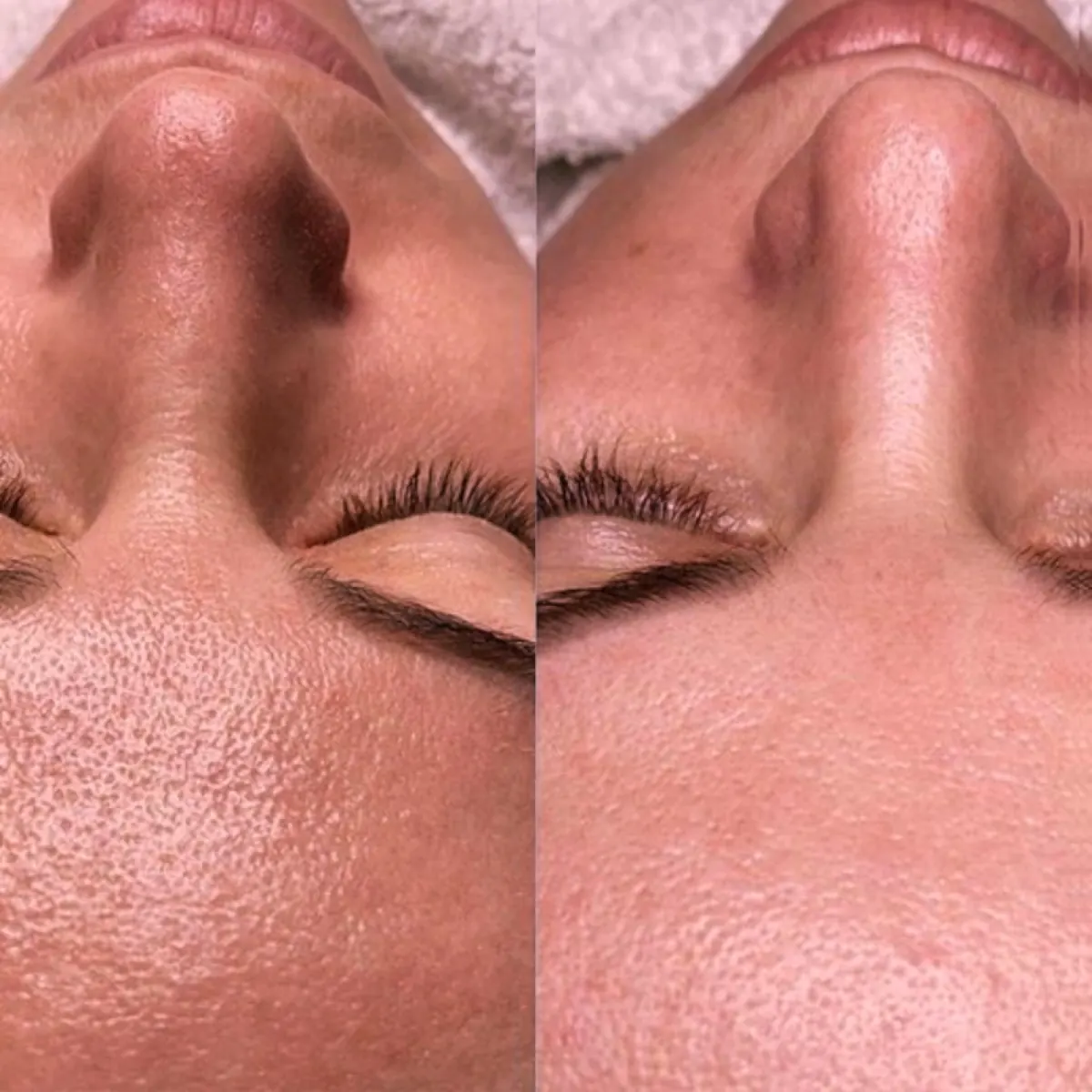 Nose skin before-and-after comparison