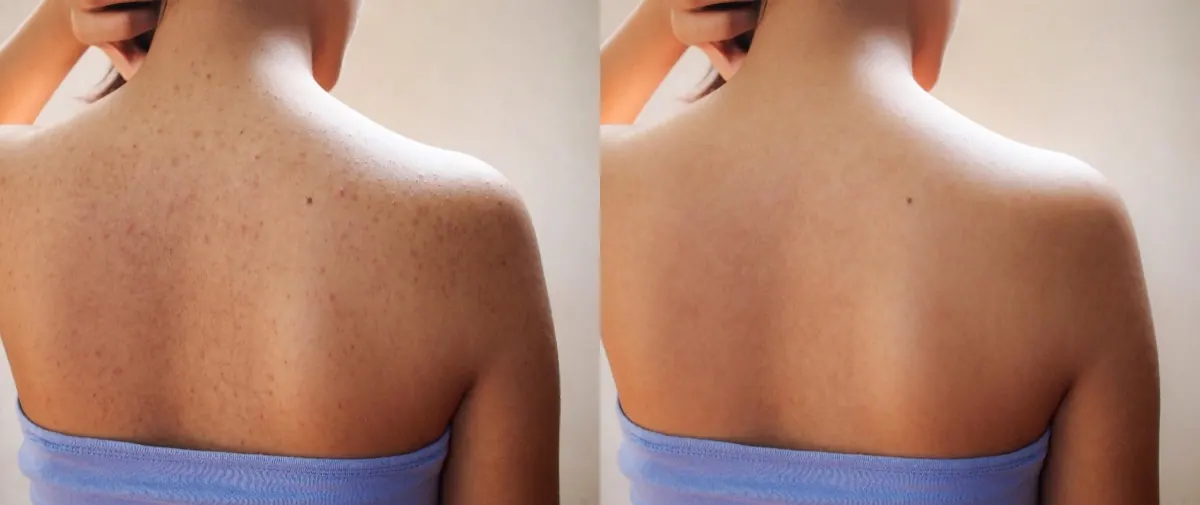 Upper-back skin before-and-after comparison