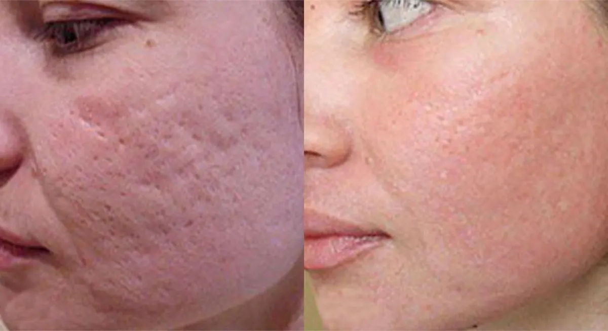 Close-up cheek texture before-and-after comparison