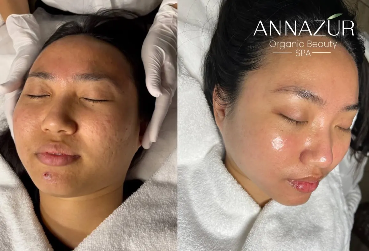 Client's face before and after an ANNAZUR facial treatment