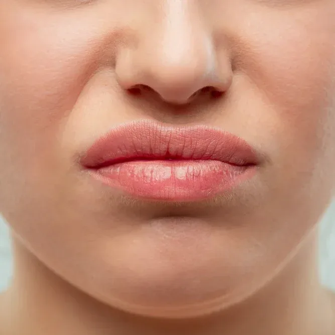 Client shows mild lip swelling resembling sunburn during normal first day healing after tattooing