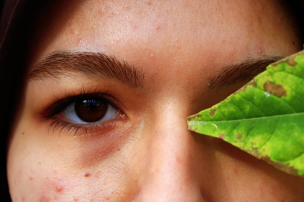 Stress causes or exacerbates acne, eczema, psoriasis, other skin diseases
