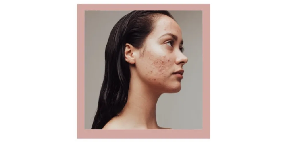 What facial is best for treating acne?